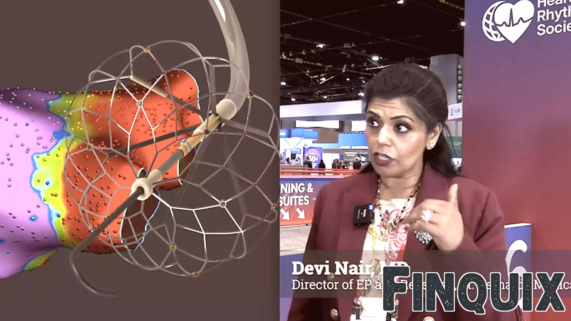 PFA has been a game-changer for heart patients—but there are still risks